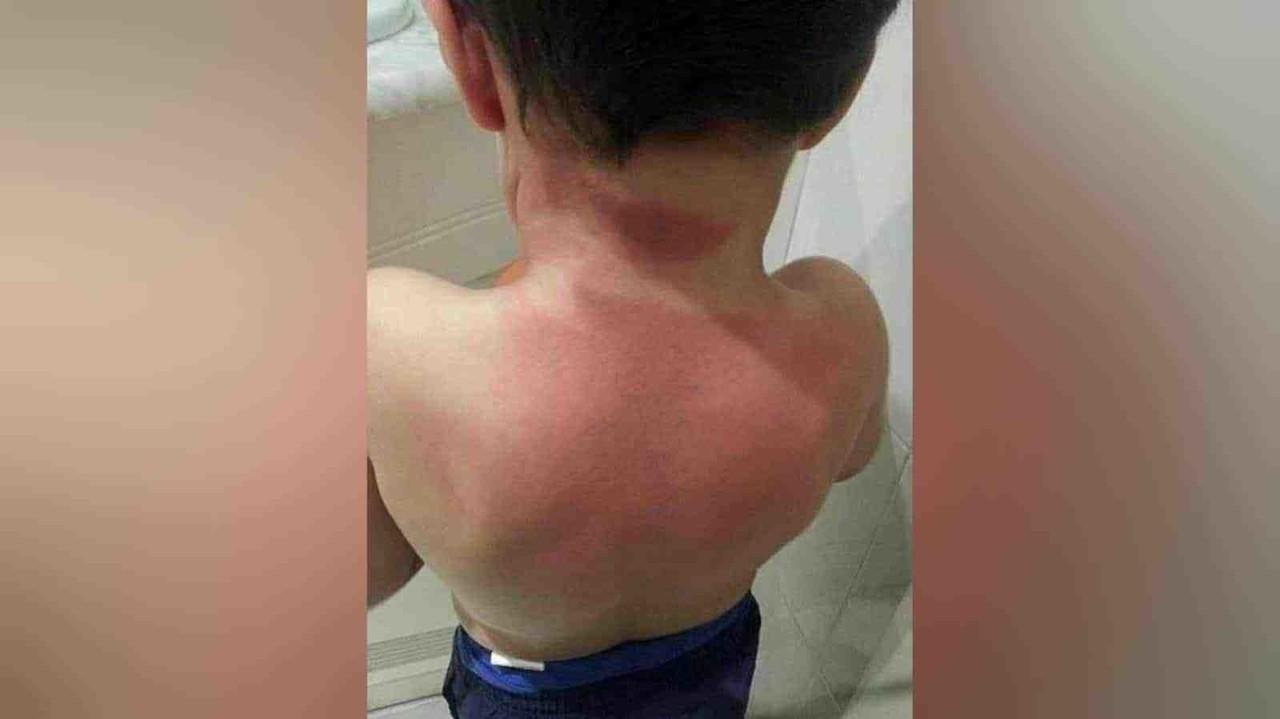 Aumentan casos de niños quemados ante época invernal