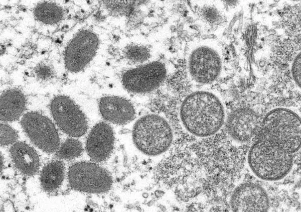 Descarta OMS pandemia por viruela símica