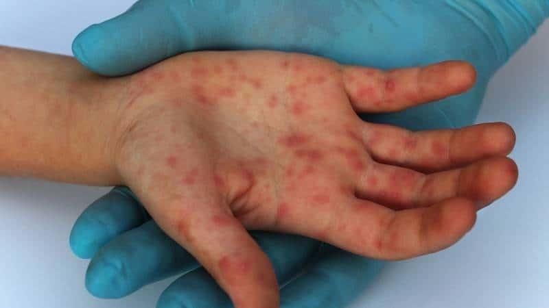 Concientiza especialista sobre viruela del mono en Nuevo León