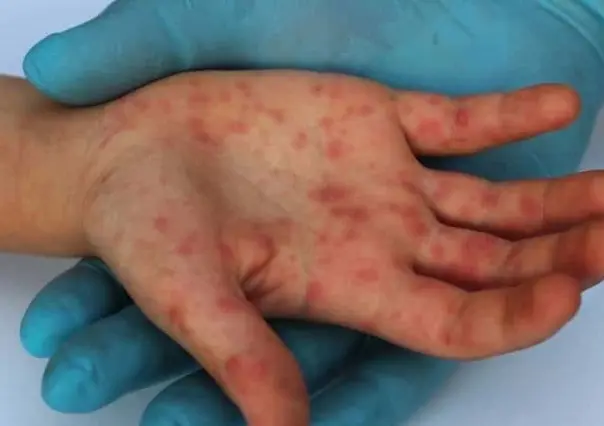 Concientiza especialista sobre viruela del mono en Nuevo León
