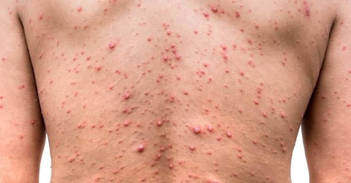 Declara OMS viruela del mono emergencia sanitaria internacional