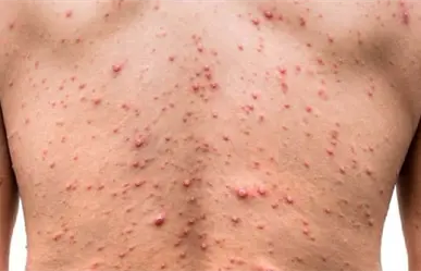 Declara OMS viruela del mono emergencia sanitaria internacional