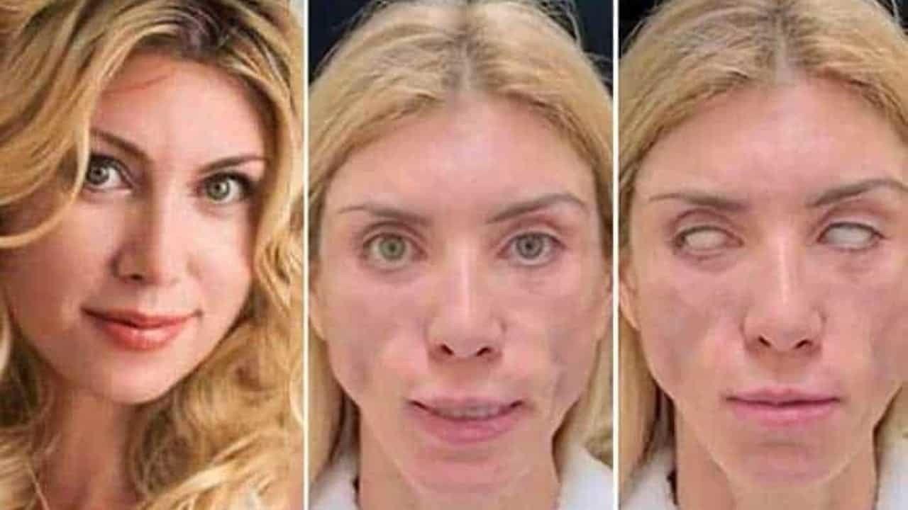 Queda desfigurada ex reina de belleza; no puede cerrar los ojos ni sonreír