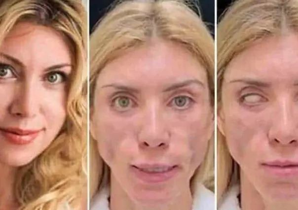 Queda desfigurada ex reina de belleza; no puede cerrar los ojos ni sonreír