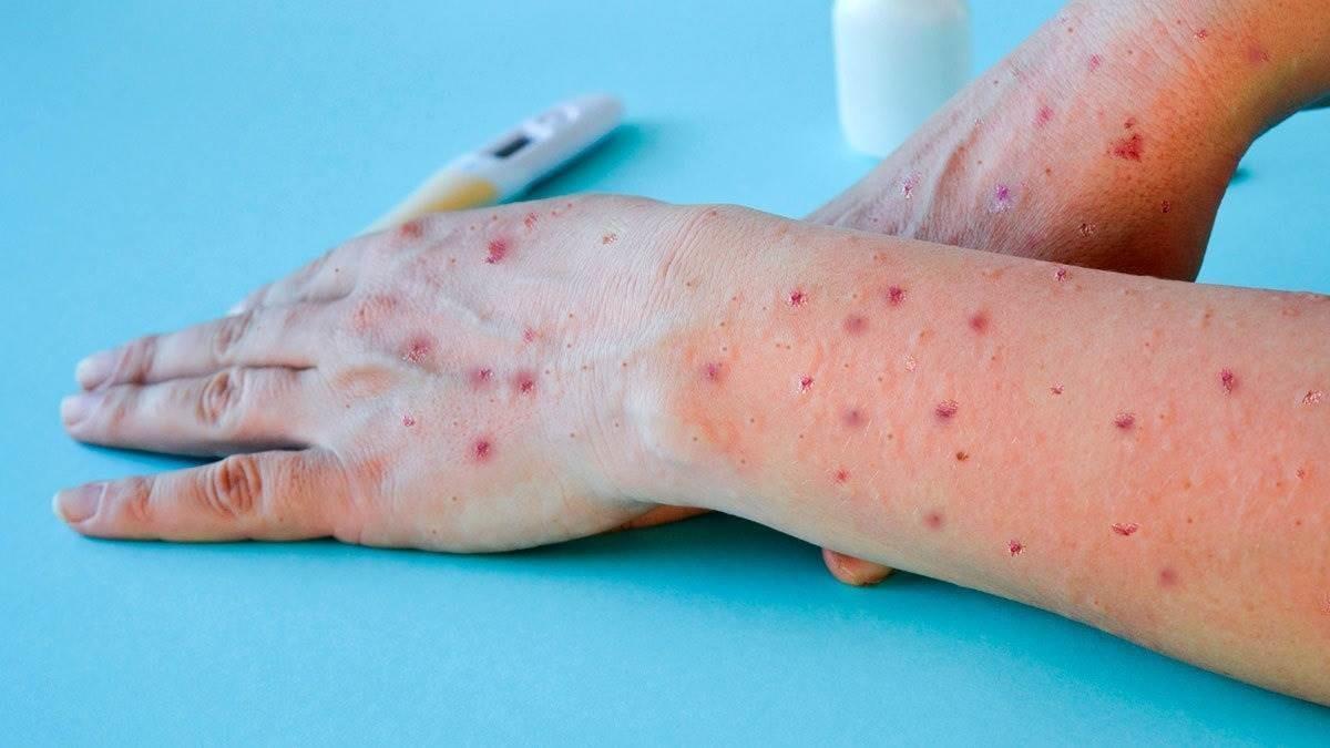 Confirma Salud 9 casos de viruela símica en Nuevo León