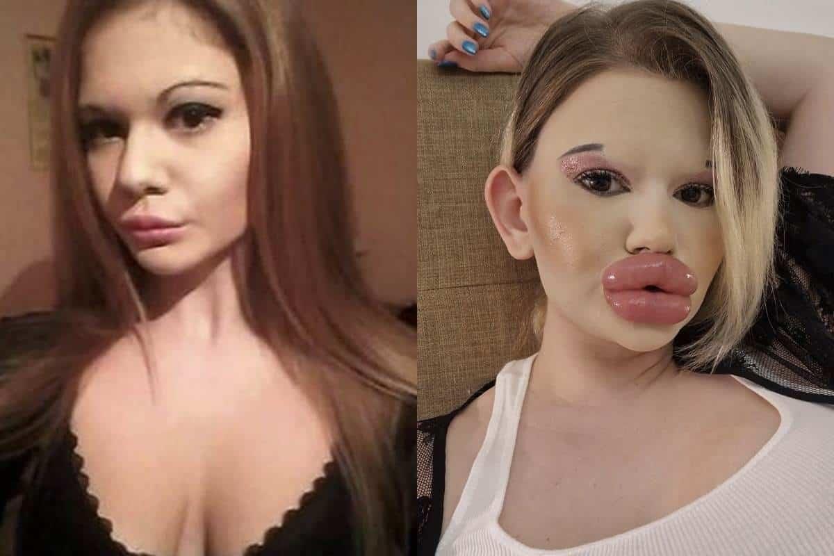 Mujer de Bulgaria presume tener los labios más grandes del mundo