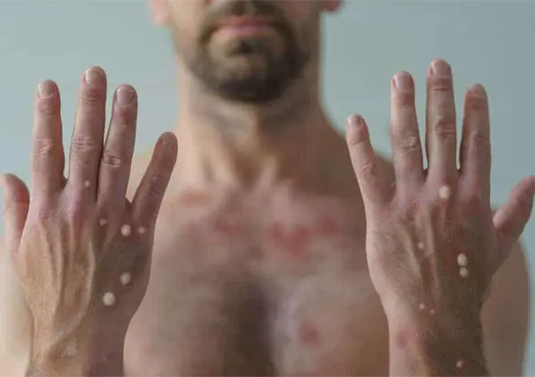 A la baja los casos de viruela símica en Nuevo León