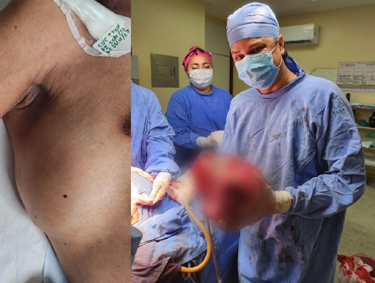 Quitan tumor de 13 kilos a paciente en hospital del IMSS en Veracruz