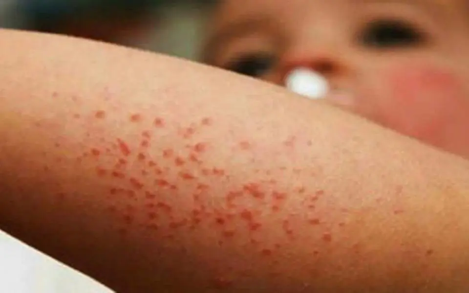 El sarampión es extremadamente contagioso y el virus puede permanecer en el aire hasta dos horas después de que una persona infectada se haya retirado del lugar. Foto: Especial.