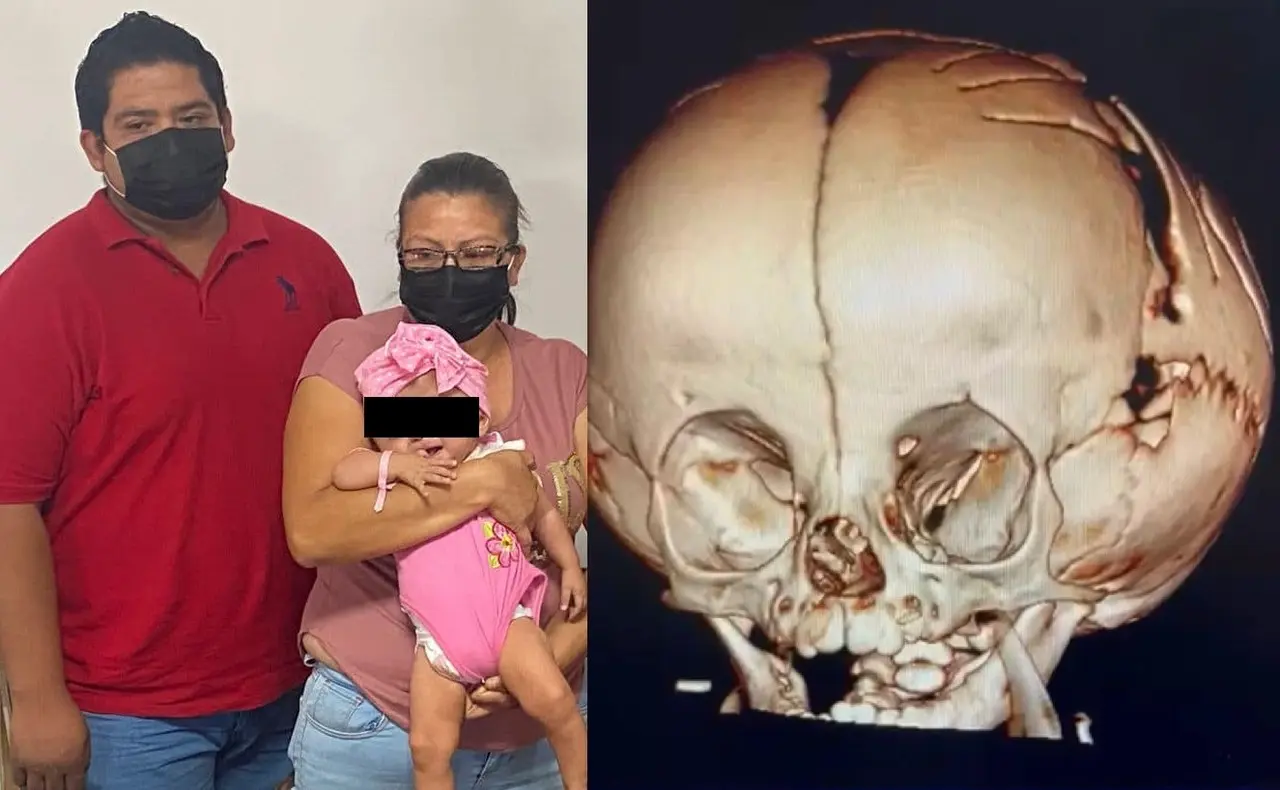 Operan con éxito a bebita por craneosinostosis en Saltillo
