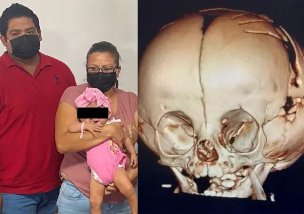 Operan con éxito a bebita por craneosinostosis en Saltillo