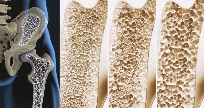 Osteoporosis y columna / Dr. Alberto Marqués