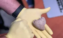 Piedras renales en mujeres yucatecas: consejos para prevenirlas