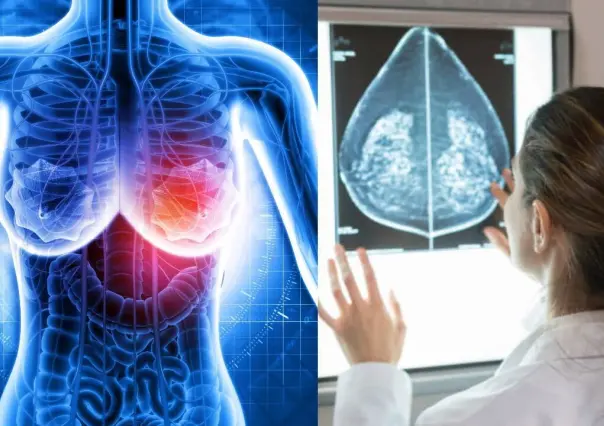 Detectan 192 casos de Cáncer de mama en Tamaulipas