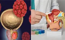 Todo sobre el cáncer de próstata: síntomas y factores de riesgo Todo sobre el cáncer de próstata: síntomas y factores de riesgo