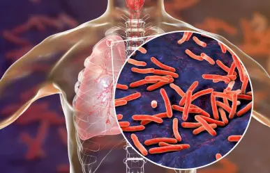 Día Mundial de la Tuberculosis: una enfermedad prevenible y tratable