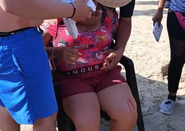 Sombrilla casi le saca el ojo a turista en Playa Miramar