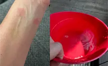 Mujer reporta daños en su piel tras bañarse con agua en alcaldía Benito Juárez Mujer reporta daños en su piel tras bañarse con agua en alcaldía Benito Juárez