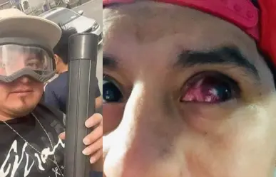 Perderá Influencer un ojo por ver el Eclipse Solar