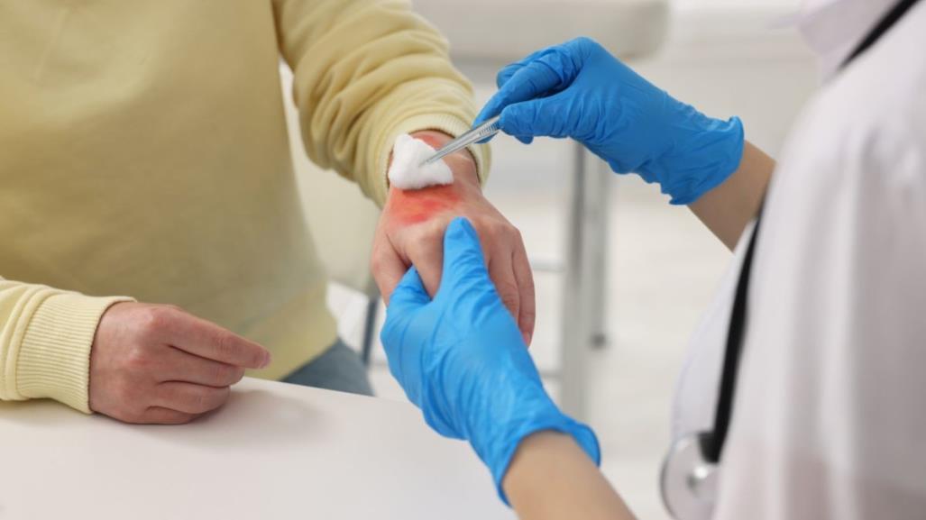 Día Nacional de la Prevención de Quemaduras: ¿Quiénes son los más vulnerables?
