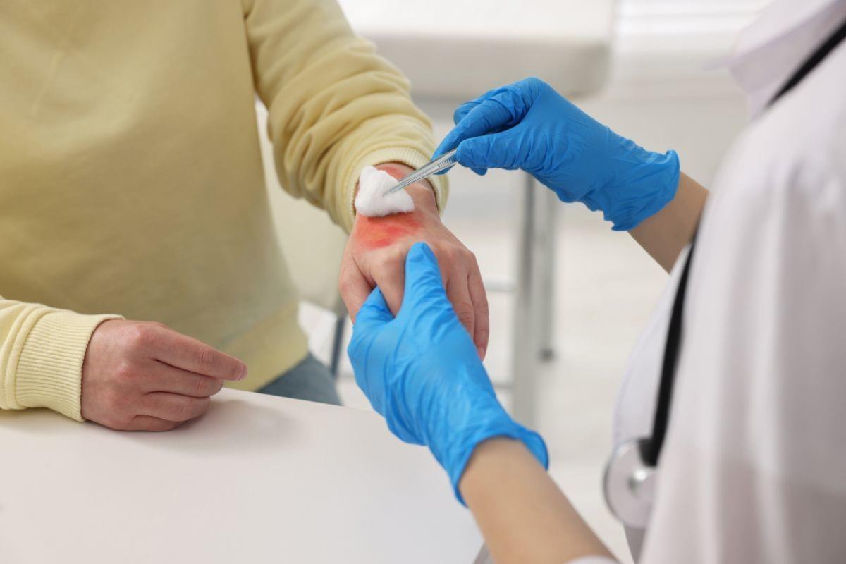 Persona con quemadura en mano siendo atendida por Doctora. Foto: Canva