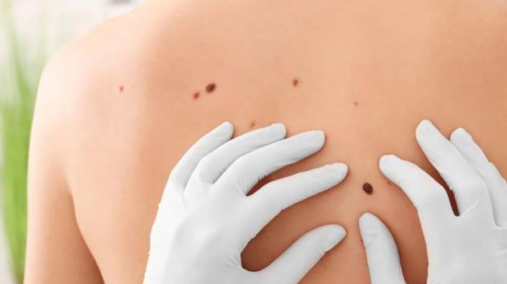 Día Mundial del Melanoma ¿Qué es y cuándo acudir con el doctor?