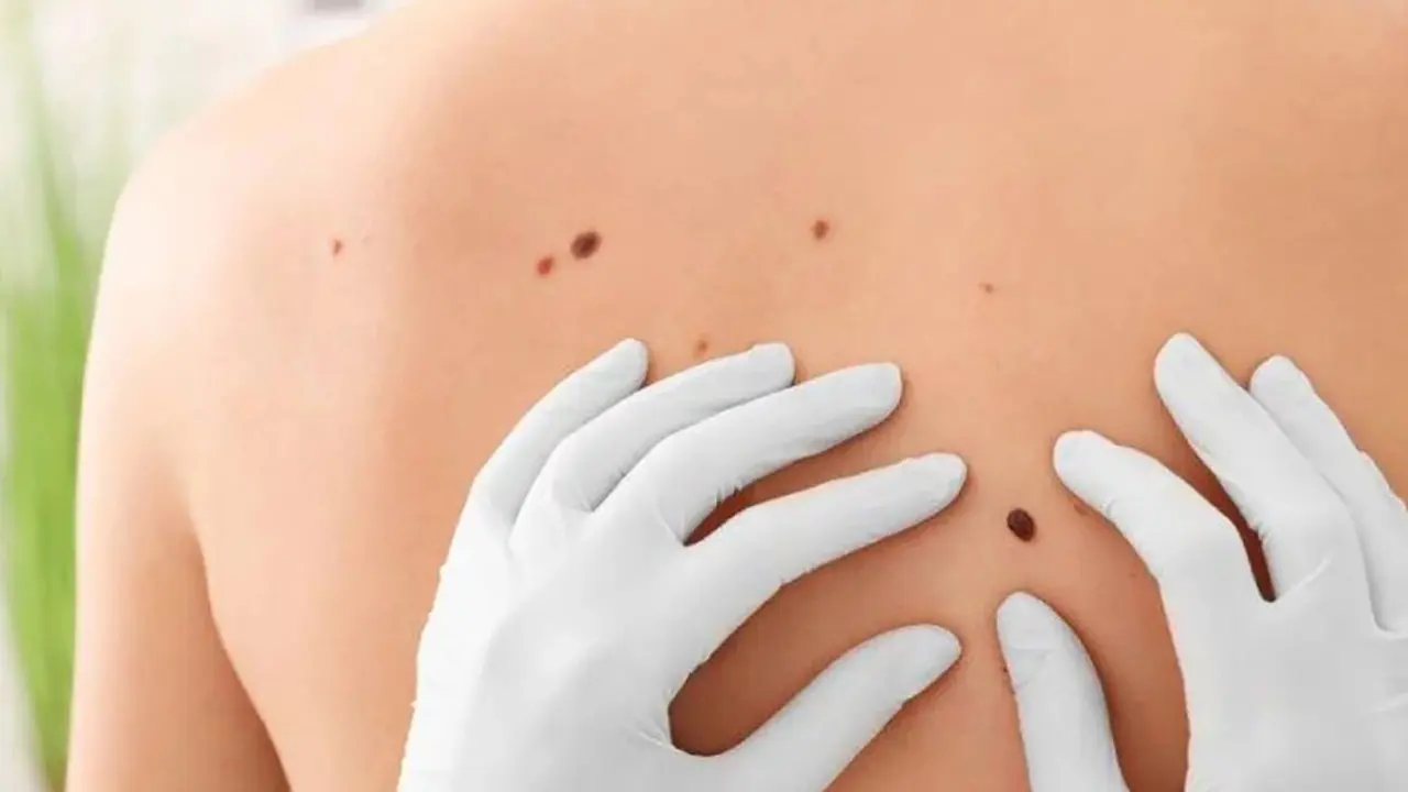 En México, el melanoma representa alrededor del 3% de los tumores, con un preocupante 80% de casos en etapas avanzadas. Foto: cuidateplus.marca.com