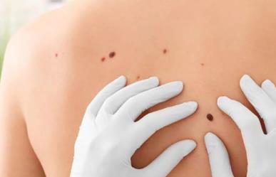 Día Mundial del Melanoma ¿Qué es y cuándo acudir con el doctor?