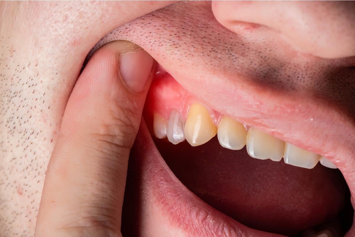 Hombre con gingivitis. Foto: @gettyimages