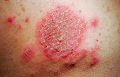 Alertan por hongo TMVII, contagioso por relaciones sexuales entre hombres