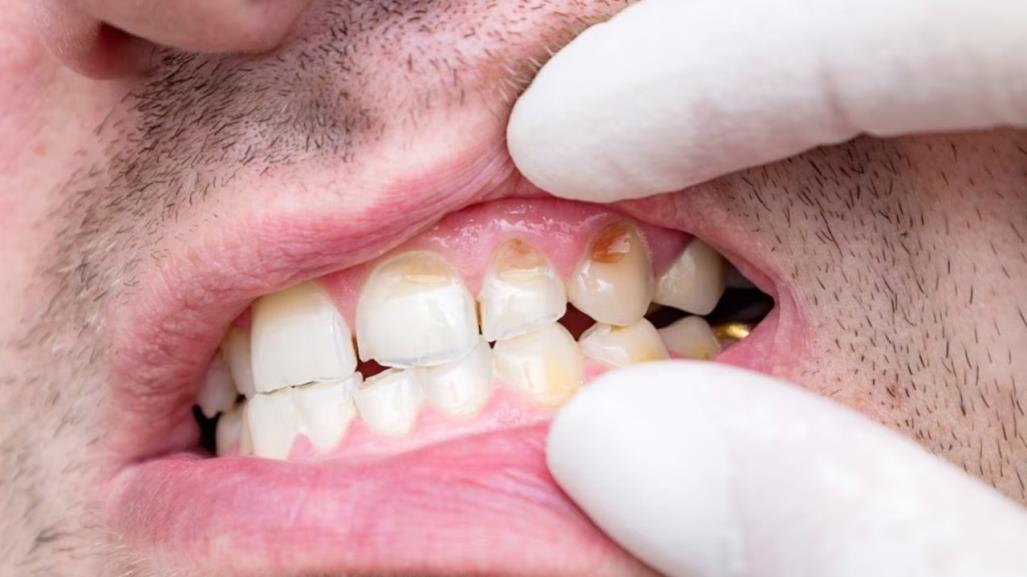 Frutas y verduras que ayudan a disminuir el sarro en los dientes