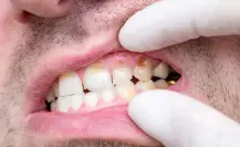 Frutas y verduras que ayudan a disminuir el sarro en los dientes