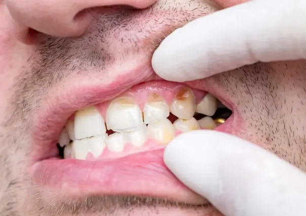 Frutas y verduras que ayudan a disminuir el sarro en los dientes