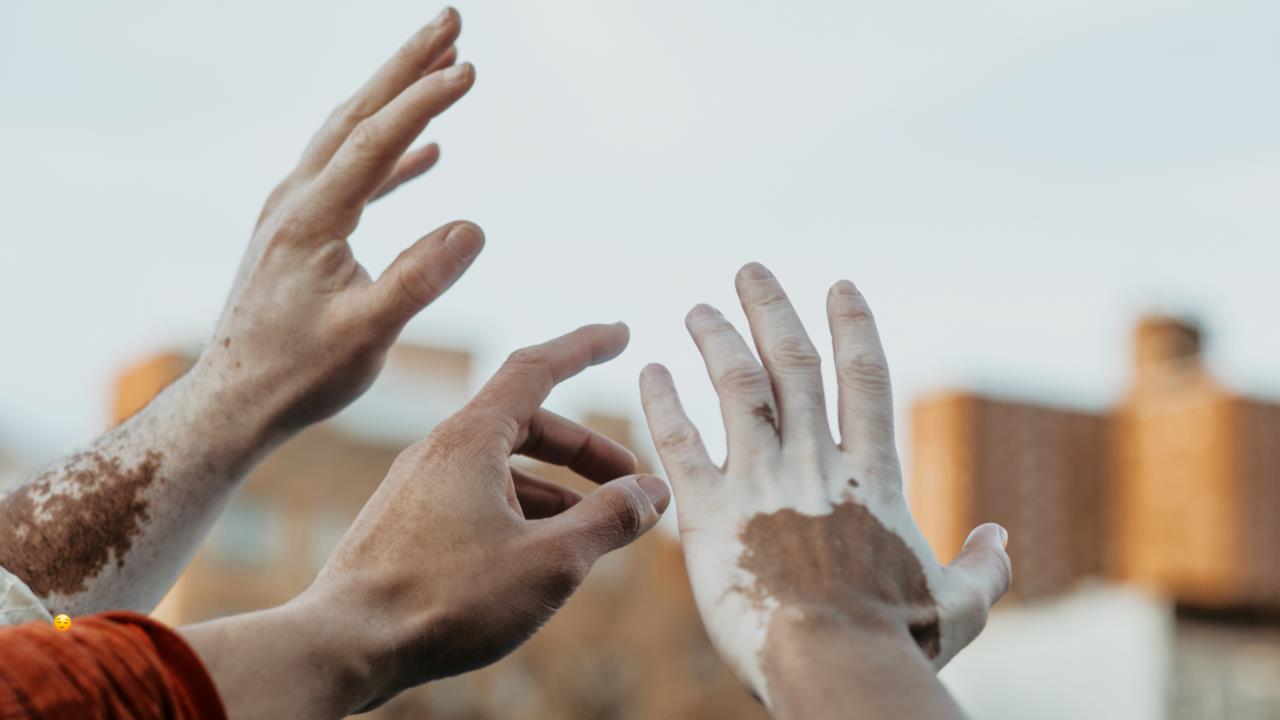 Personas con vitiligo posando a manera de reflexión / Foto: CANVA