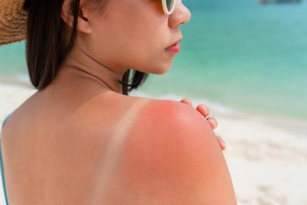 Mujer con la espalda quemada por el sol Foto: Pexels