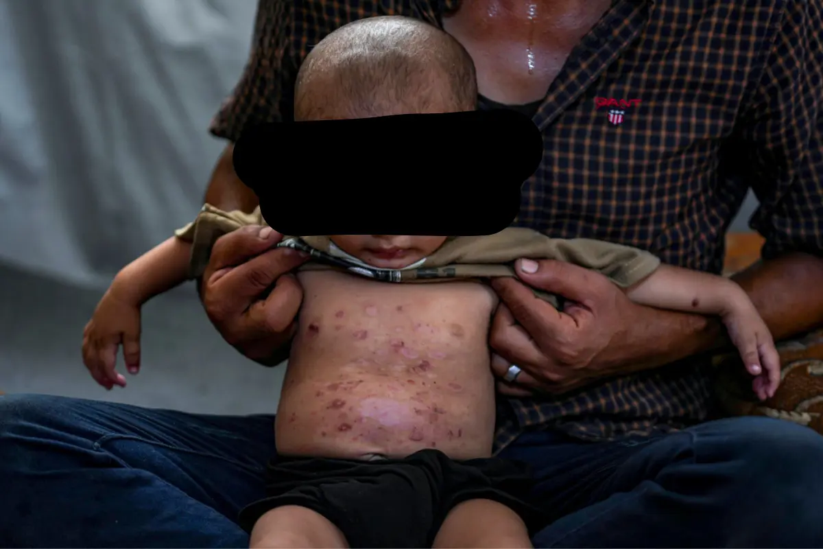 Mohammed Abu Obaid, un niño palestino que padece una enfermedad de la piel, posa para una fotografía junto a su padre en un campamento para desplazados por la guerra en Deir al-Balah, Franja de Gaza, el lunes 29 de julio de 2024. (Foto AP/Abdel Kareem Hana