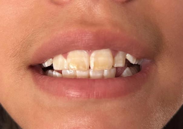 ¿Miedo al dentista? 9 de cada 10 duranguenses no atienden enfermedades dentales