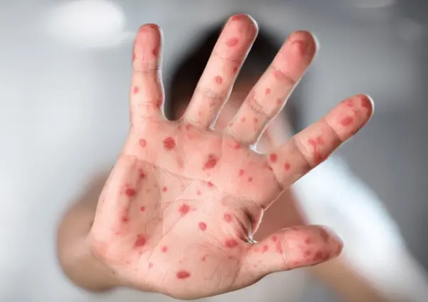 ¿Qué es la mpox? OMS declara emergencia internacional por viruela del mono