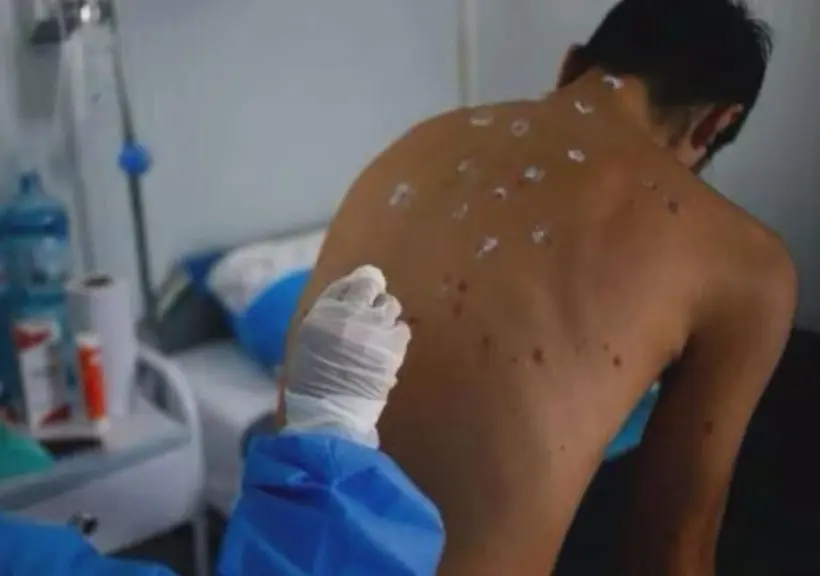 Un hombre siendo atendido por las lesiones en su cuerpo derivado del mpox. Foto: Notisur.