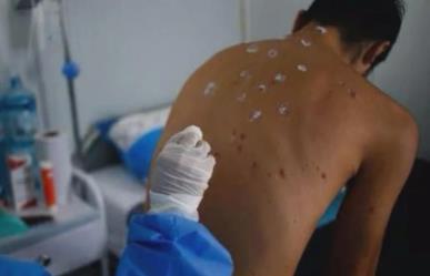 Morelos registra dos casos de Viruela del Mono
