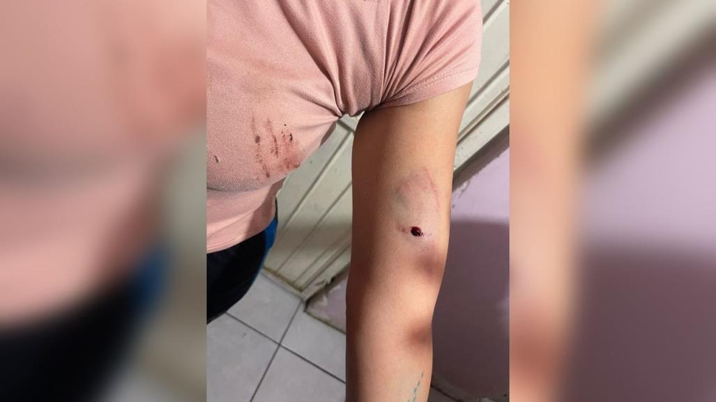 Mujer herida por proteger a sus hijos de dos pitbulls