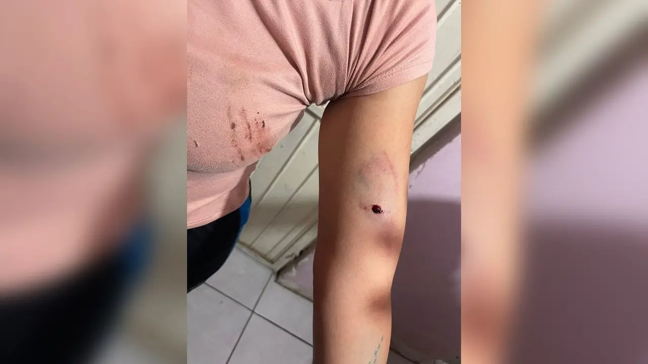 Lesiones sufridas por una mujer tras ser atacada por un perro Pitbull. Foto: Especial.