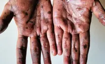 Yucatán, sin casos de mpox por ahora, se mantiene la vigilancia