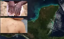 ¿Llegó la Viruela del Mono a Yucatán? Esto se sabe sobre los casos en la región