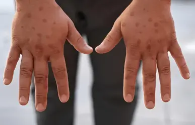 Más de 50 casos de viruela símica confirmados en México; CDMX lidera contagio