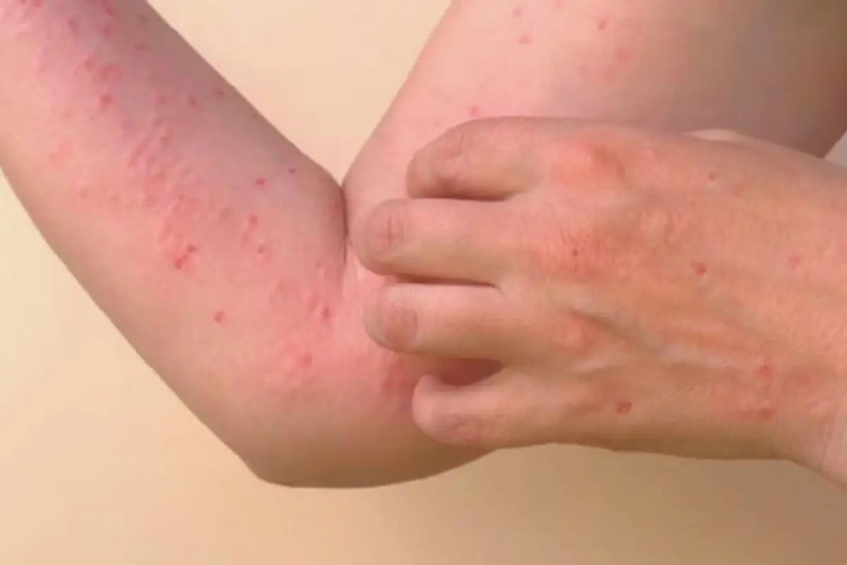 En la semana del 18 al 24 de agosto, la Secretaría de Salud reportó seis nuevos contagios de mpox. Foto: Reuters
