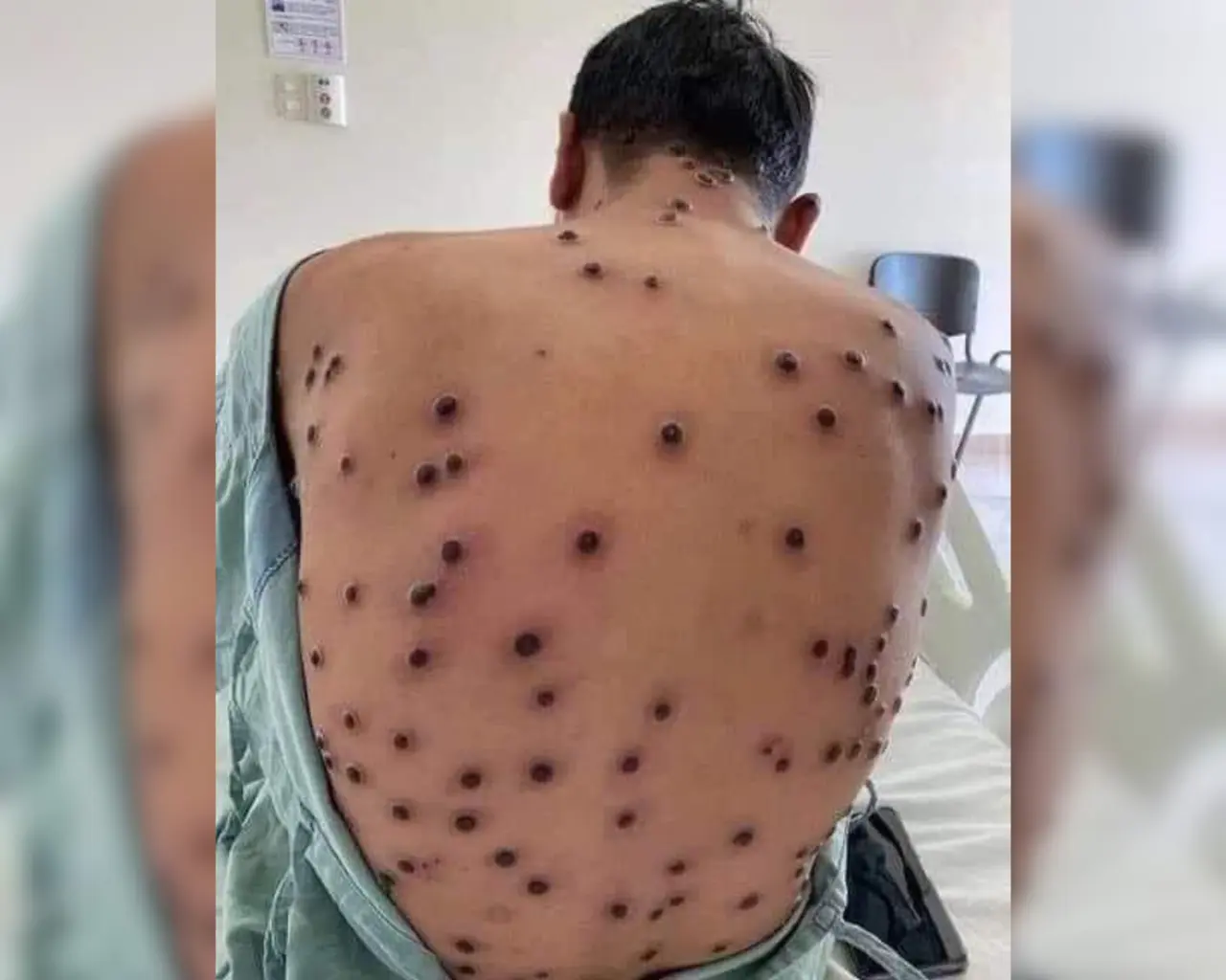 La Secretaría de Salud de Tamaulipas ha intensificado la vigilancia epidemiológica y la capacitación del personal médico tras confirmarse 32 casos de viruela del mono en el estado desde 2022. Foto: Redes sociales