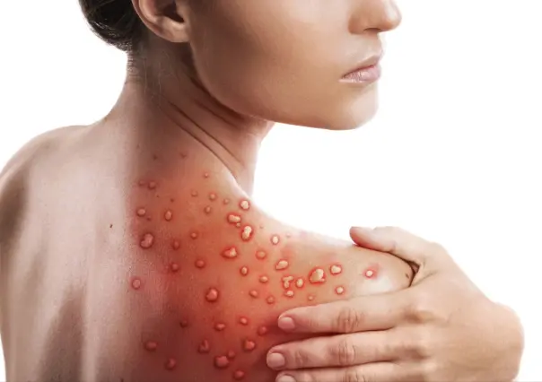 Aumentan casos de Mpox en Baja California Sur