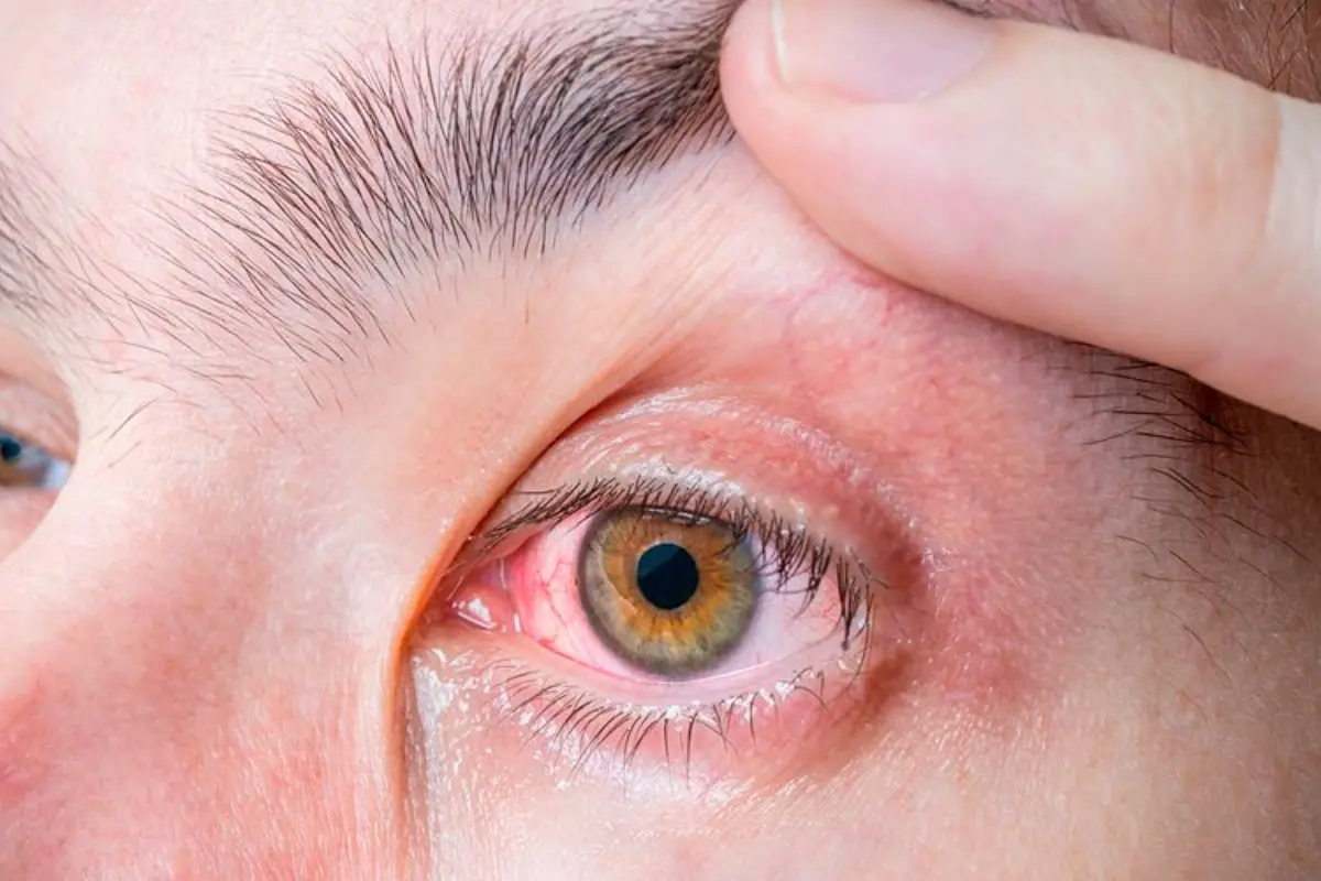 La conjuntivitis se caracteriza por el enrojecimiento de uno o ambos ojos, además de una sensación de picazón en la zona. Foto: Oftalmología al Día