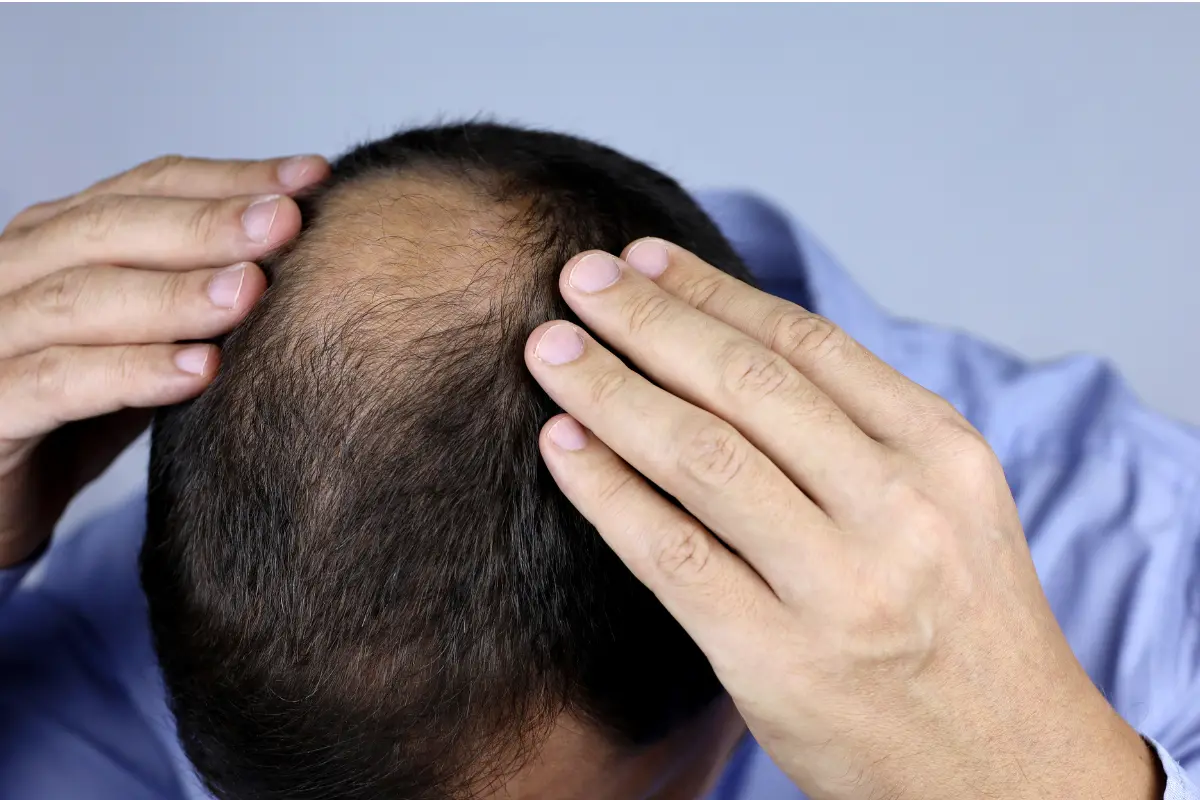 Consejos para cuidar tu cabello en este día del calvo. Foto: Oleg Elkov